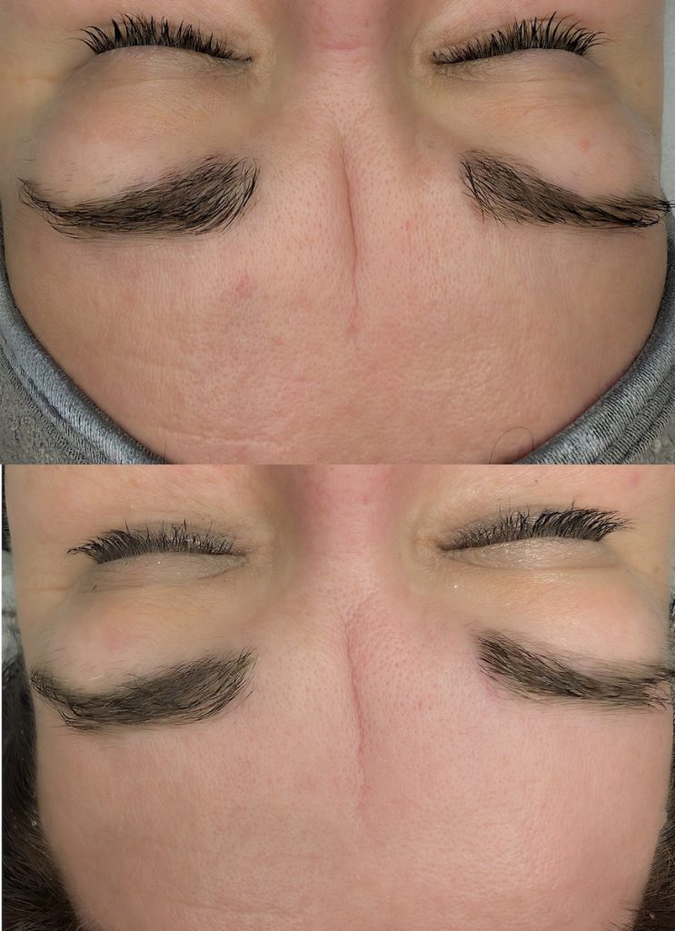 Efekt fotoodmładzania - na zdjęciu u góry przed serią zabiegów, na zdjęciu u dołu po czwartym zabiegu. Na zdjęciu widać zdecydowanie zmniejszoną lwią zmarszczkę na czole klientki