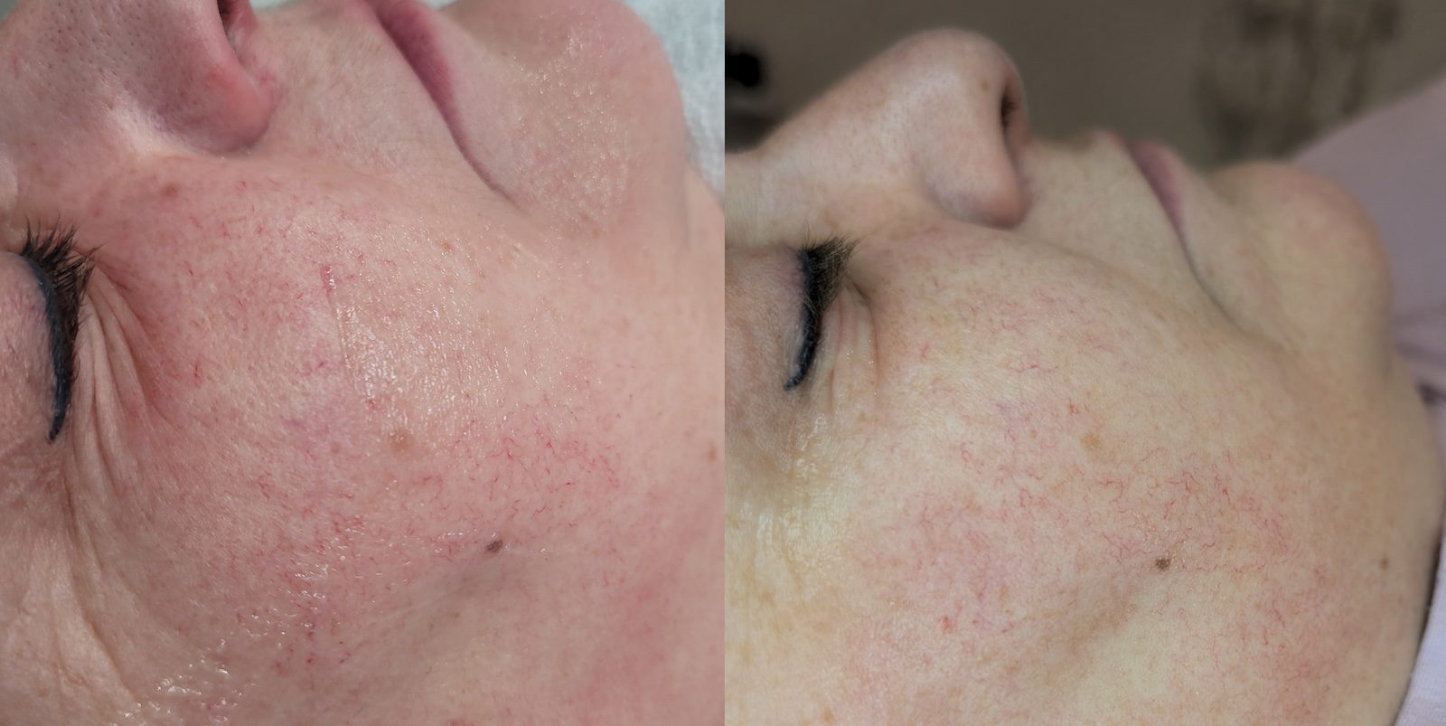 Efekt fotoodmładzania - na zdjęciu po lewej przed serią zabiegów, na zdjęciu po prawej po trzecim zabiegu. Na zdjęciu widać zdecydowanie płytsze zmarszczki i poprawiony koloryt skóry.